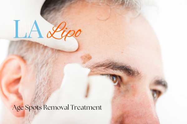 What Are the Most Effective Treatments for Age Spots Woodham Ferrers?