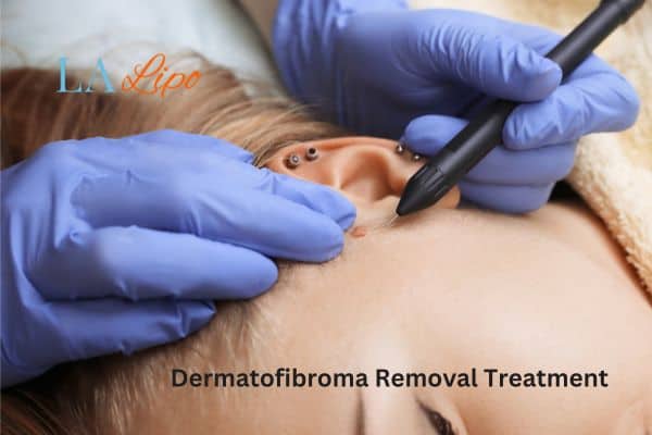 Dermatofibroma Removal Treatment Woodham Ferrers