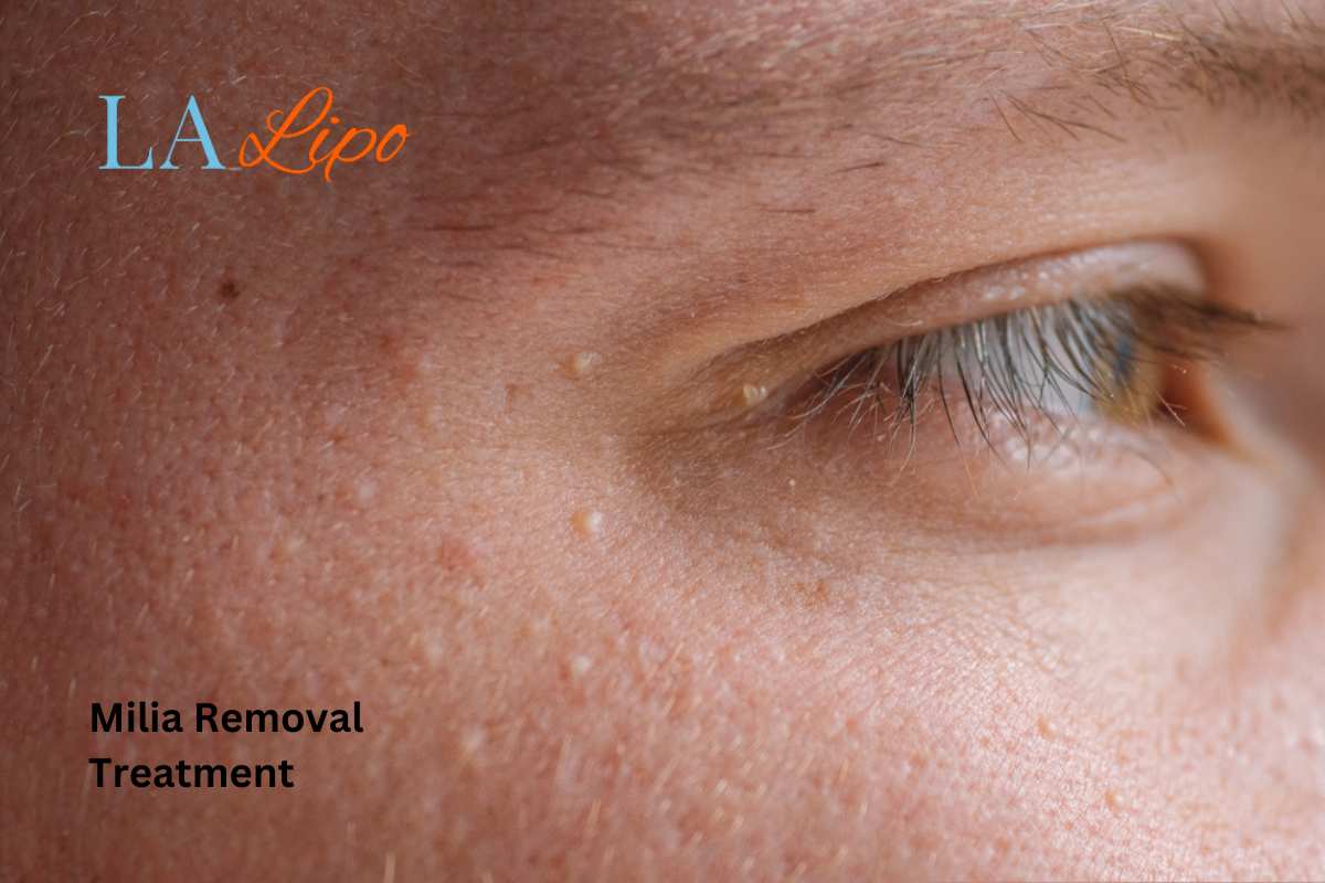 Cryopen Milia Removal: Is It the Easiest and Safest Option Woodham Ferrers?