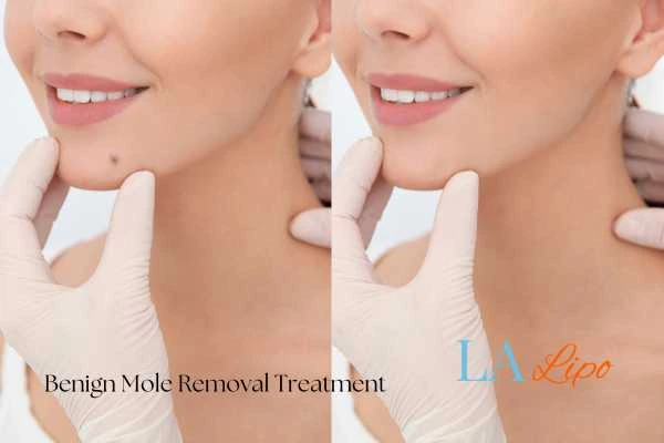 Before-and-after results following benign mole-removal treatment Woodham Ferrers