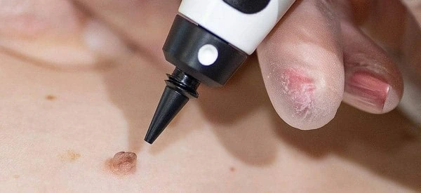 skin tag removal using cryopen Woodham Ferrers