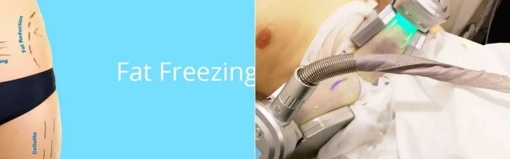 Fat freezing Woodham Ferrers on multiple areas of the body
