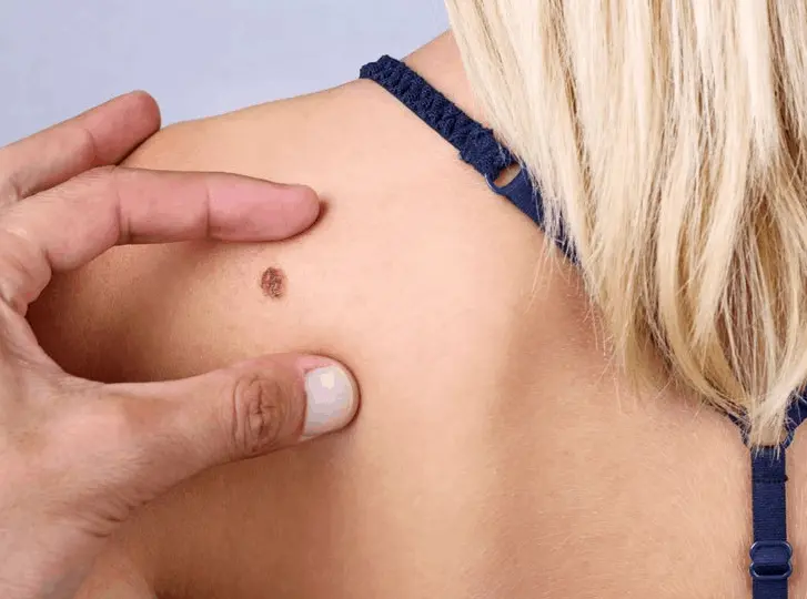 woman having mole removal Woodham Ferrers consultation before treatment.