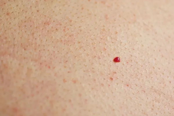 close up of a cherry angioma Woodham Ferrers