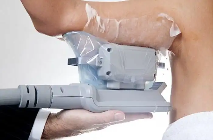 Picture of fat freezing Woodham Ferrers on the upper arms.