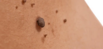 image of a skin tag Woodham Ferrers