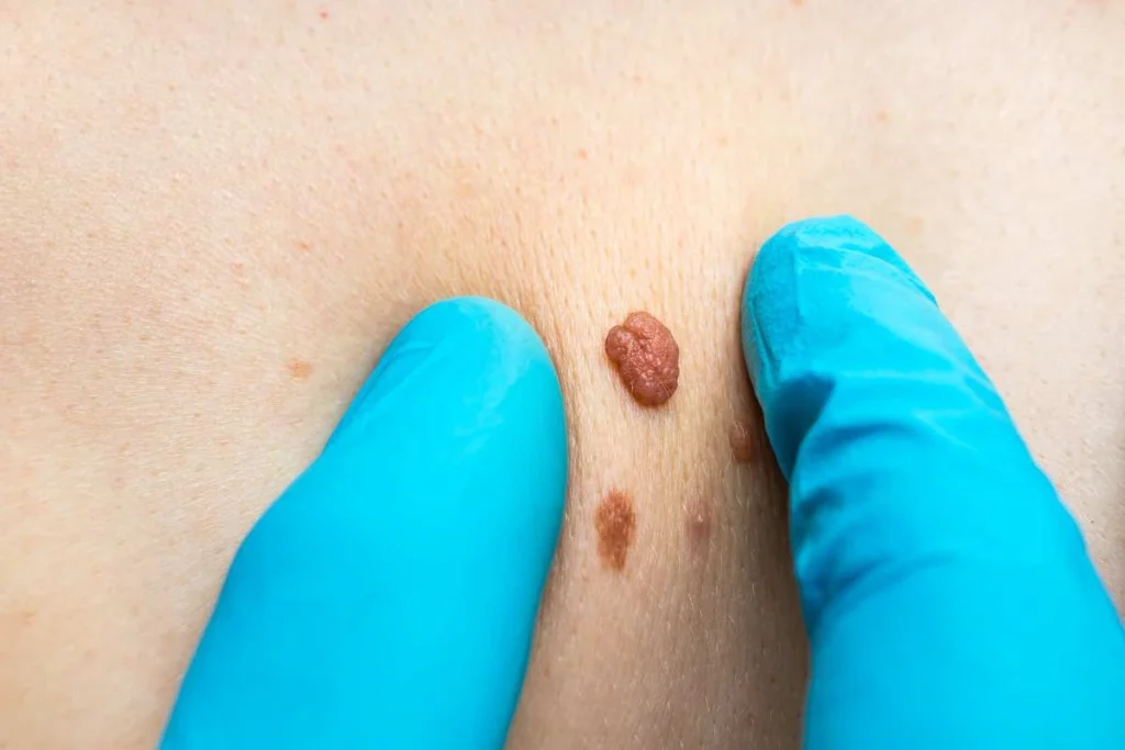 Consultant examining a skin tag Woodham Ferrers