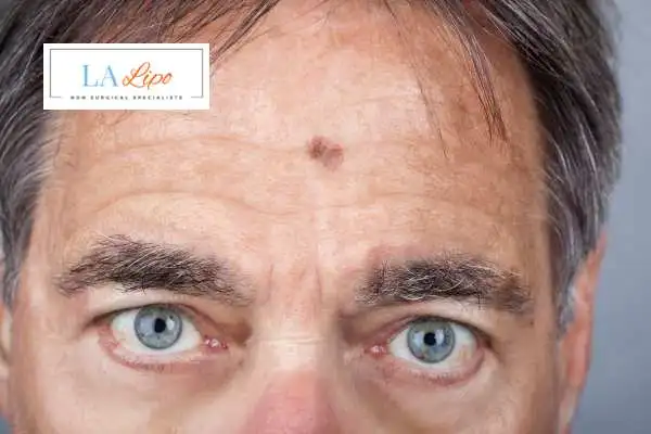 Solar Lentigo Removal Woodham Ferrers image of man with mark on his forehead