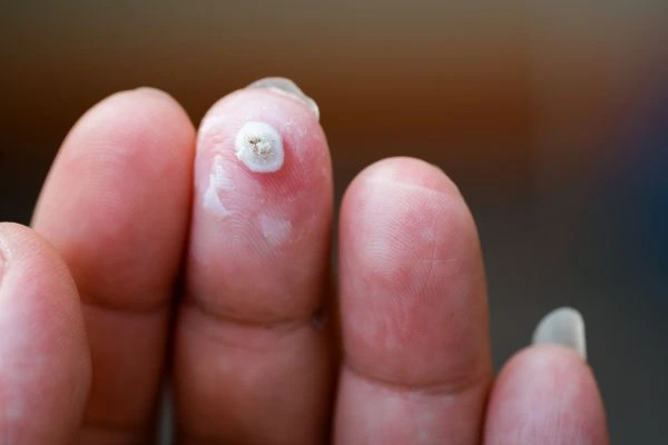 wart on person finger - cryotherapy to treat from LA LIPO Woodham Ferrers