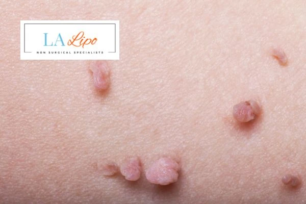 Does cryopen skin tag removal Woodham Ferrers hurt? Find out now call our team today!