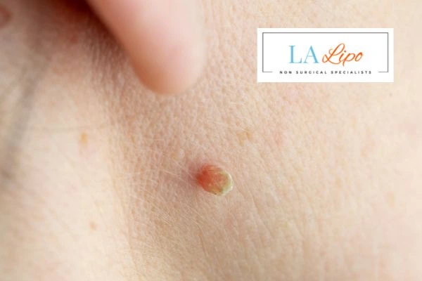 Book skin tag removal Woodham Ferrers today speak to our team now!