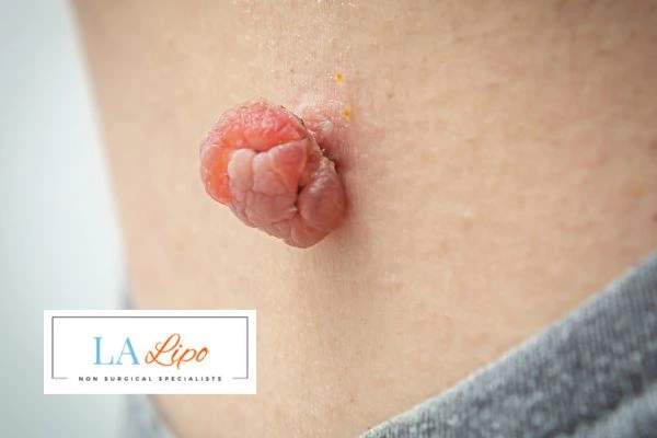 Interested in skin tag removal Woodham Ferrers? Concerned about the pain? Find out more today!