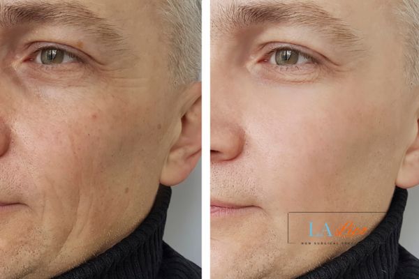 See the amazing results of Morpheus8 Treatment Woodham Ferrers!