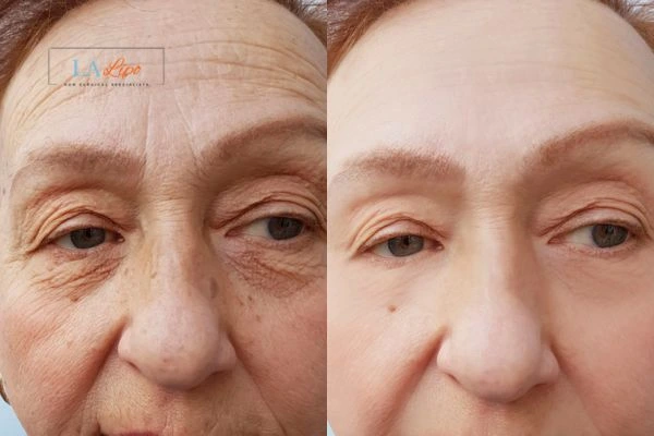 The powerful benefits of Morpheus8 Treatment Woodham Ferrers - Call Our team today!