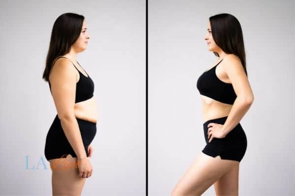 Picture of womans before and after using LA-EMS body sculpting to improve her core strength Woodham Ferrers