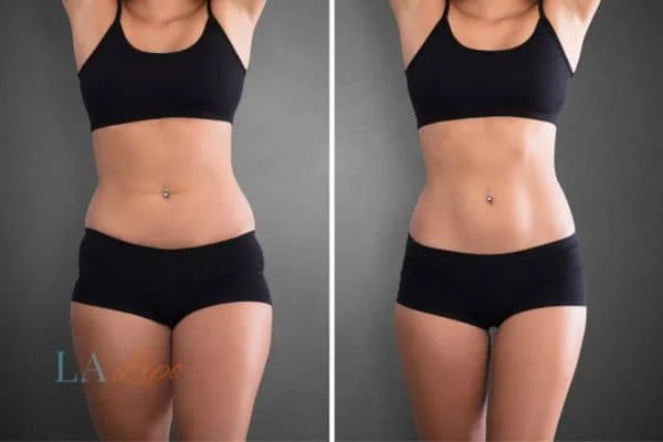 before and after results of non-surgical treatment to help a woman's body image and mental health Woodham Ferrers