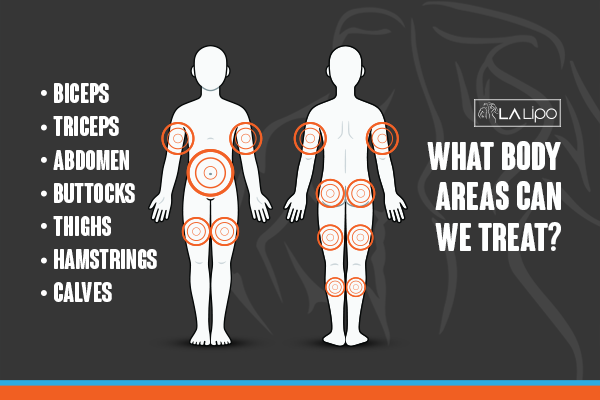 Diagram to show areas you can have LA-EMS Body Sculpting Treatment Woodham Ferrers