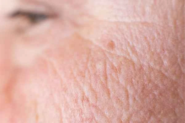 close up picture of a woman's face showing an age spot Woodham Ferrers