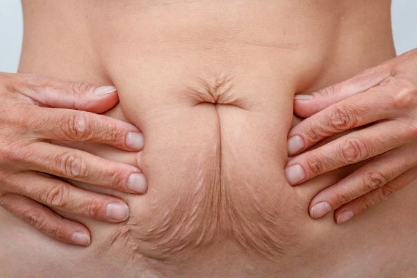 Image of a woman's stomach with loose skin - example of skin tightening Woodham Ferrers options
