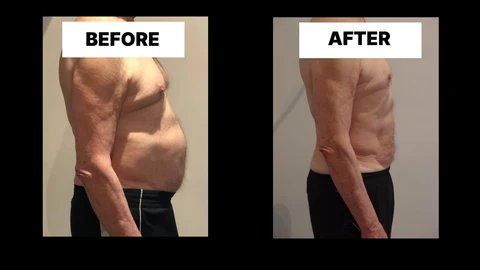 What Symptoms Can Diastasis Recti Cause in Men? Weak Core, Back Pain and Poor Posture Woodham Ferrers